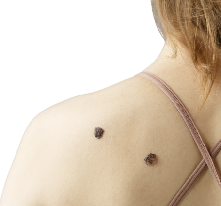 Акция: Зональное удаление папиллом